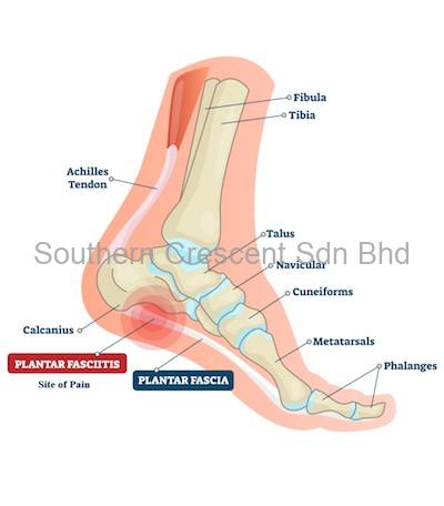 Plantar Fasciitis