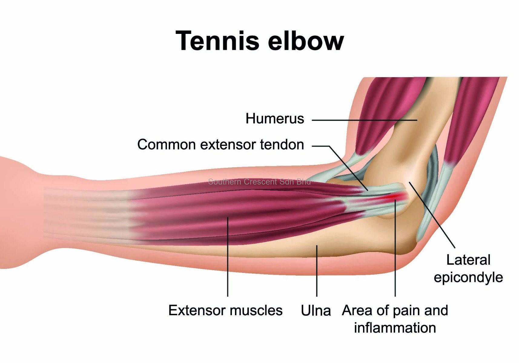 Tenis Elbow